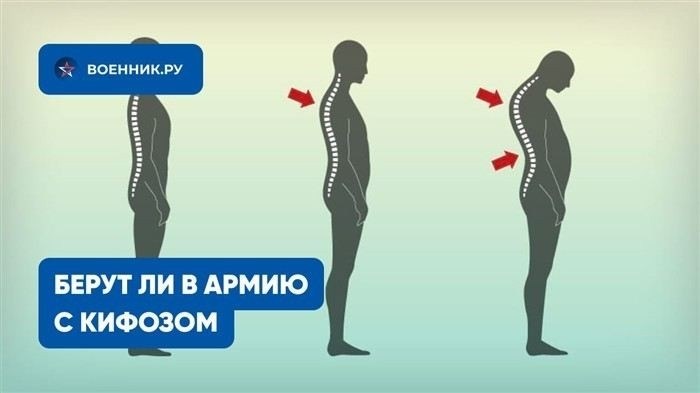 Что такое кифоз и какие его формы учитываются при медицинском освидетельствовании