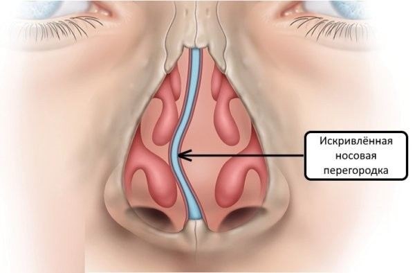 Искривление носа и отсрочка от армии: возможные варианты