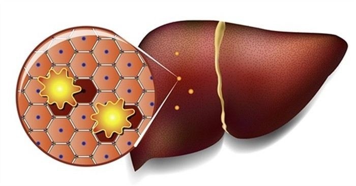Как стеатогепатоз влияет на годность к военной службе?