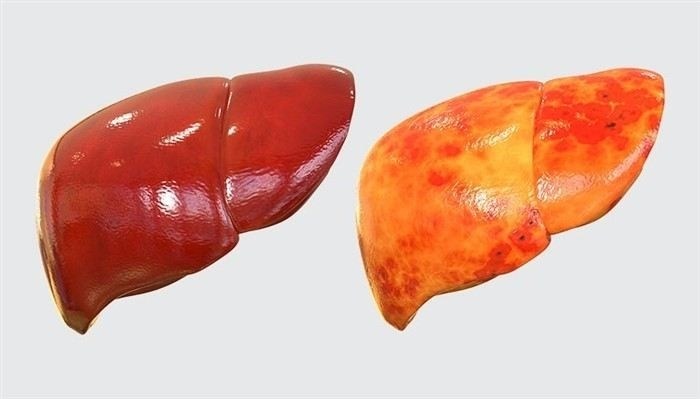 Какие последствия могут возникнуть при игнорировании симптомов жирового гепатоза?