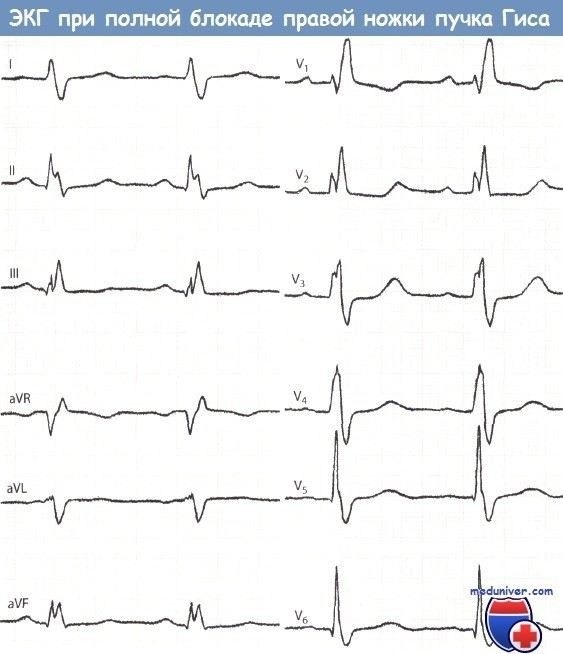 Блокада правой ножки пучка Гиса: причины и диагностика