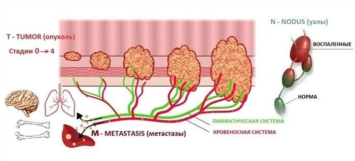 Рак слепой кишки: классификация по стадиям и международная TNM-система