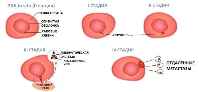 Диагноз Т11-9: Степени прогрессирования и стадии рака