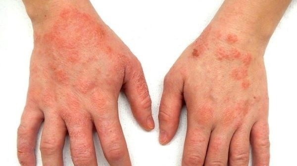 С какими проявлениями экземы в армию берут?