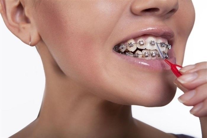 Профилактика заболеваний при ношении брекетов