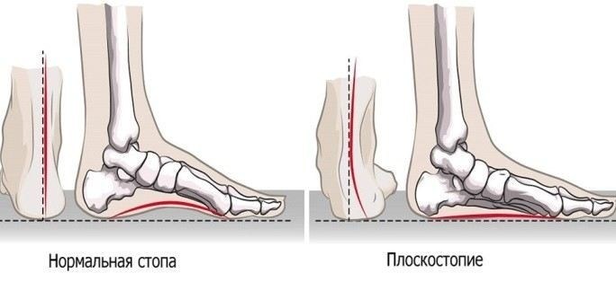 Методы лечения плоскостопия и их влияние на возможность прохождения службы