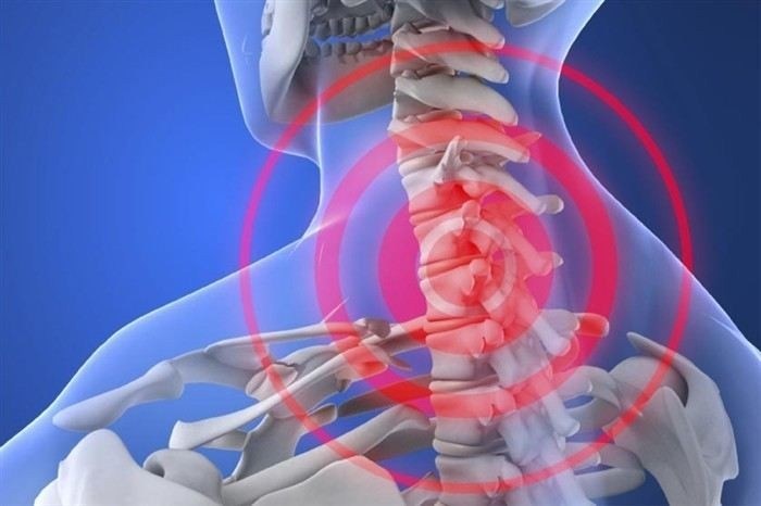 Симптомы подвывиха шейного позвонка и как распознать клинику заболевания