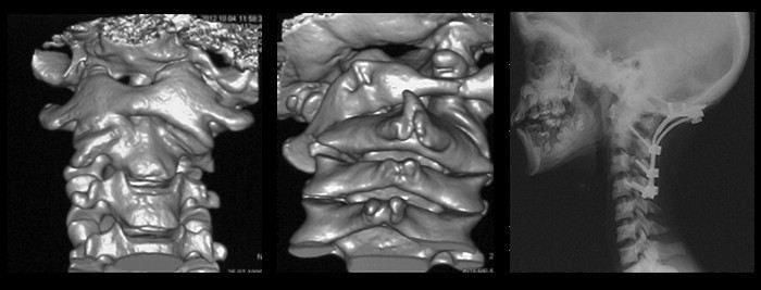 Стадии и степени нестабильности шейного отдела позвоночника