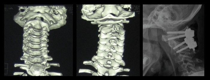 Нестабильность шейного отдела позвоночника и армия: можно ли служить?