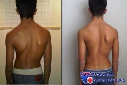 Какие стадии сколиоза не позволяют пройти военную комиссию