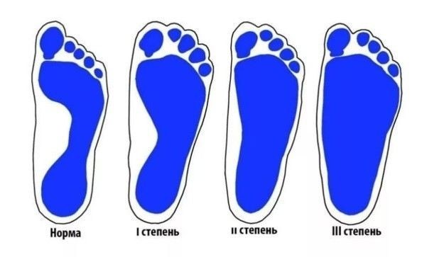 Как продольное плоскостопие влияет на пригодность к военной службе