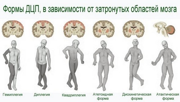 Церебральный паралич.